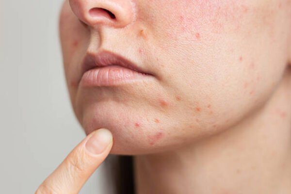 Can Acne Treatment improve skin clarity