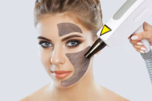 Can Laser Carbon Peeling Shrink Large Pores