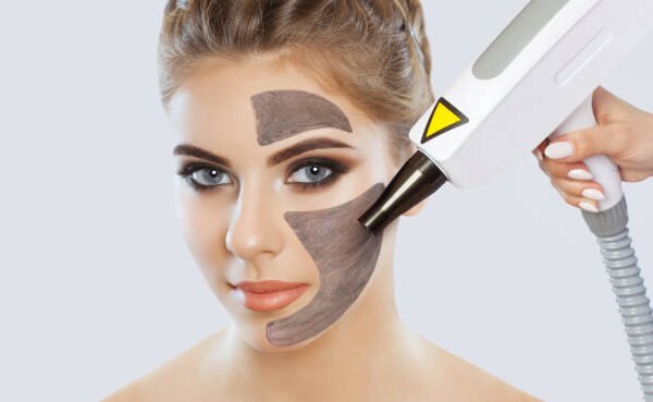 Can Laser Carbon Peeling Shrink Large Pores