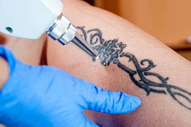 Can Laser Tattoo Removal Remove Colored Tattoos