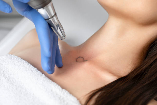 Can Laser Tattoo Removal Remove Neck Tattoos
