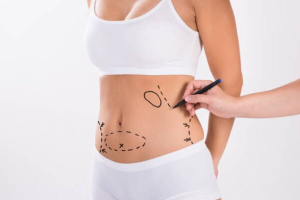 Can Liposuction Improve Overall Body Proportions
