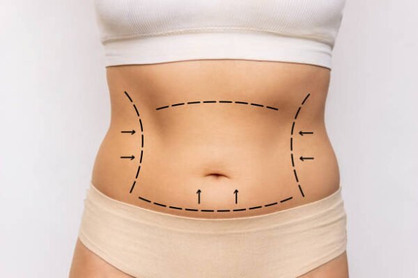 Can Mini Tummy Tuck Tighten Lower Abdominal Muscles