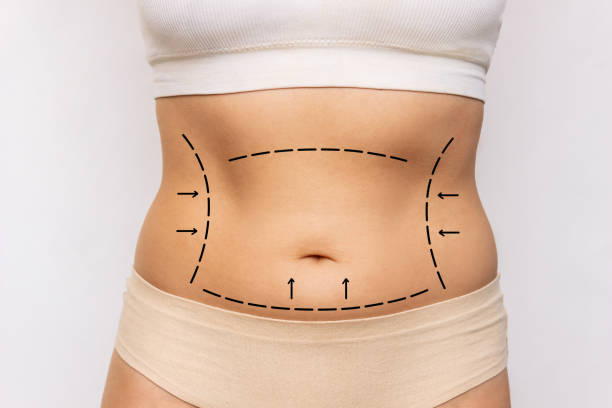 Can Mini Tummy Tuck Tighten Lower Abdominal Muscles
