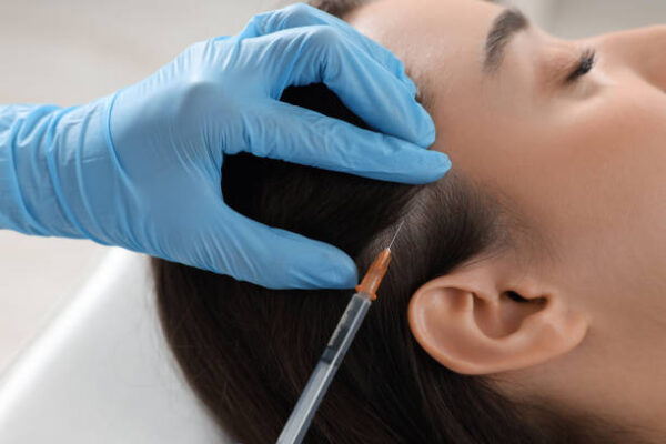 Can PRP Hair Treatment restore a fuller hairline