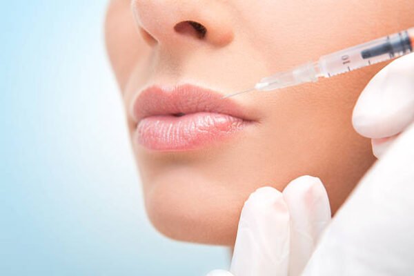 Can Russian Lip Fillers Enhance Your Smile Naturally