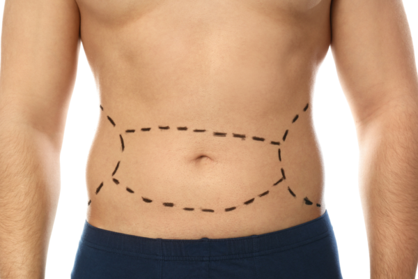 Bariatric Surgery Abu Dhabi