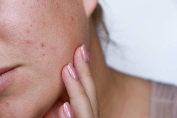 Does Laser Acne Scar Treatment work for everyone