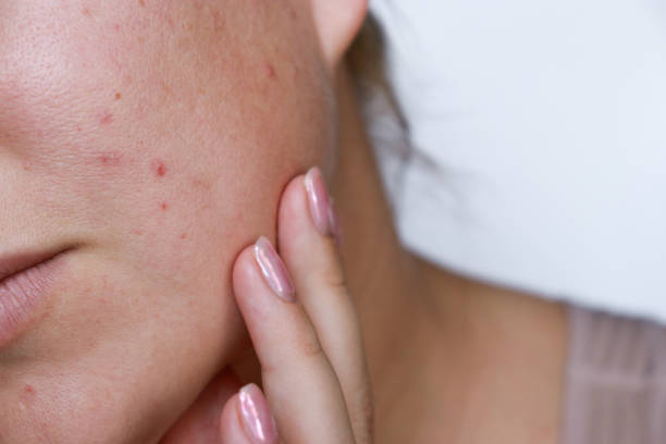 Does Laser Acne Scar Treatment work for everyone