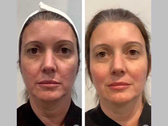 Customized Thread Lift Treatment in Dubai for Firmer, Healthier, Glowing Facial Skin