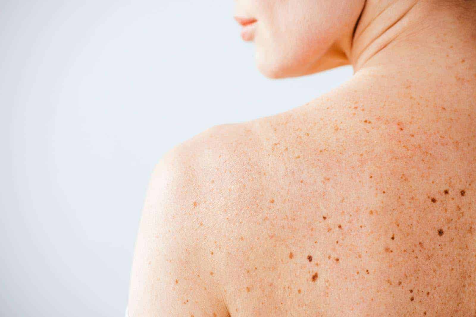 Seborrheic Keratosis Treatment in Abu Dhabi
