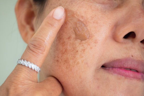 Melasma Treatment in Abu Dhabi