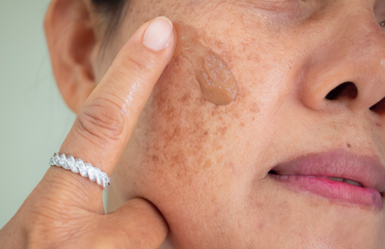 Melasma Treatment in Abu Dhabi