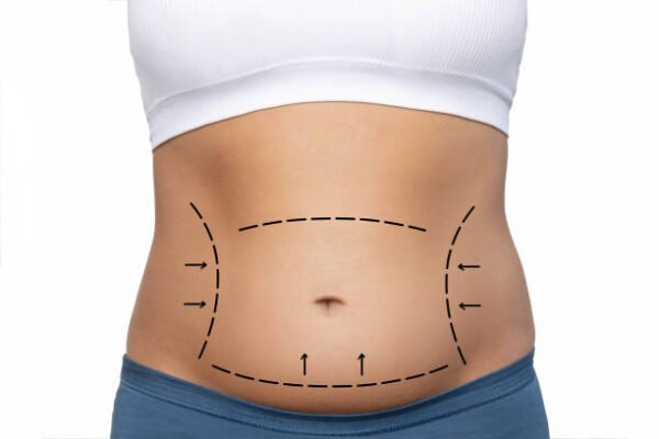 How Does Mini Tummy Tuck Improve Body Shape