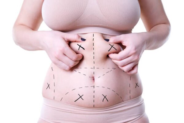 How Long Do Tummy Tuck Results Really Last