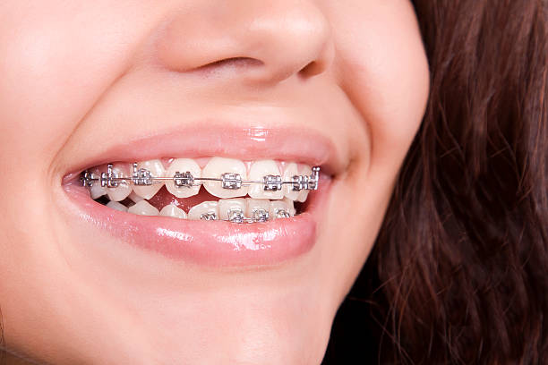 How Long Does Dental Braces Treatment Take