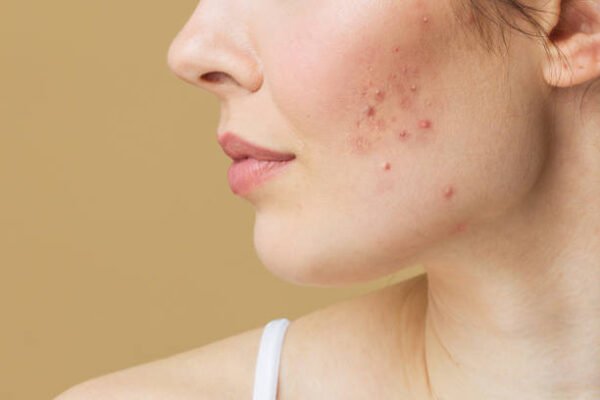 How Many Sessions for Laser Acne Scar Treatment