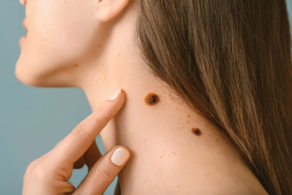 Skin Lesion Removal Abu Dhabi