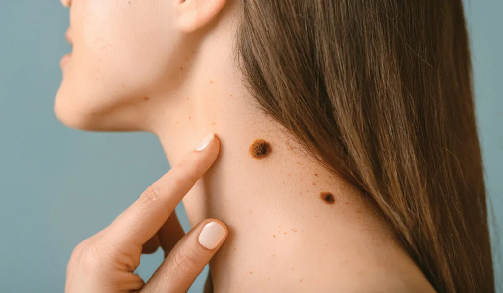 Skin Lesion Removal Abu Dhabi