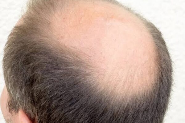 Crown Hair Transplant in Abu Dhabi