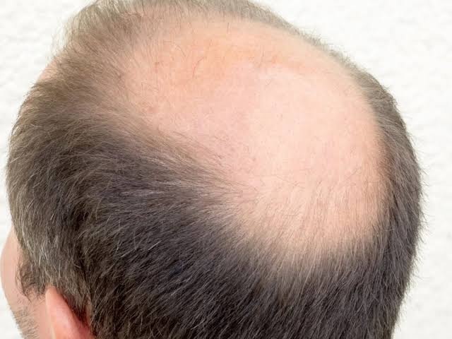 Crown Hair Transplant in Abu Dhabi