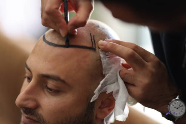 Is FUE Hair Transplant the Right Hair Loss Treatment