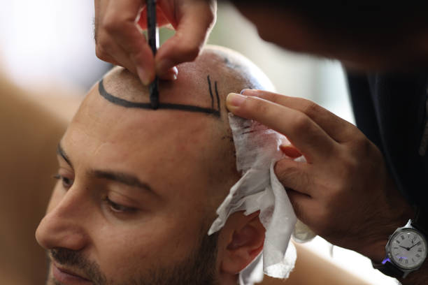 Is FUE Hair Transplant the Right Hair Loss Treatment