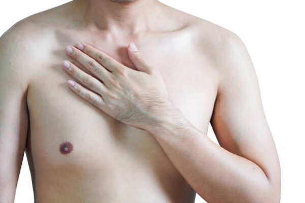 Is Gynecomastia Surgery suitable for athletes