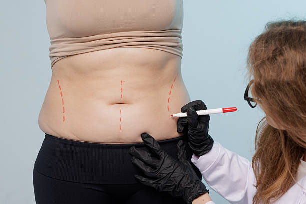 Is Liposuction the best fat removal treatment