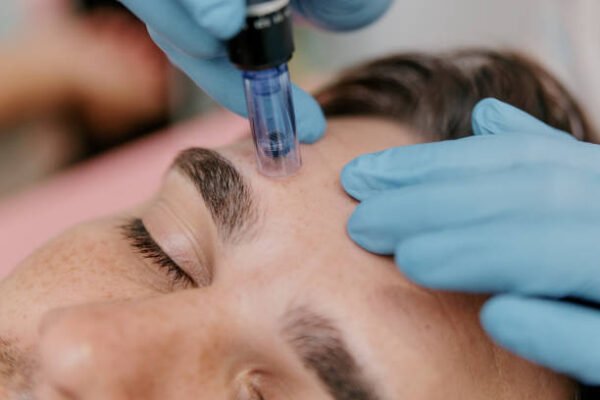 Is Microneedling Effective for Men Too