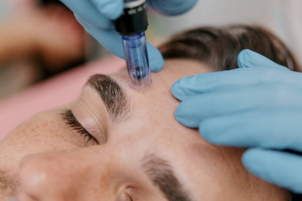 Is Microneedling Effective for Men Too