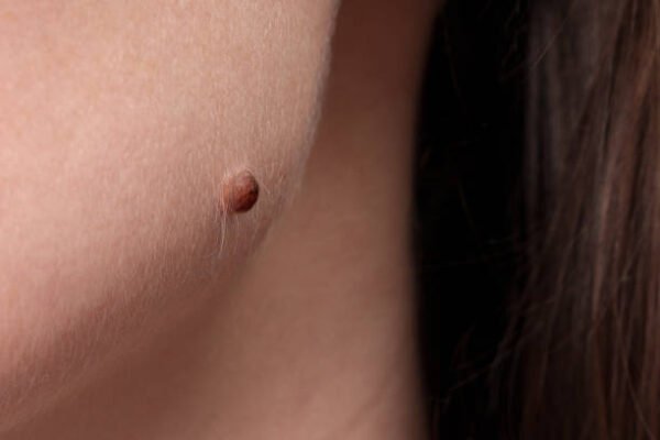 Is Mole Removal safe for sensitive skin