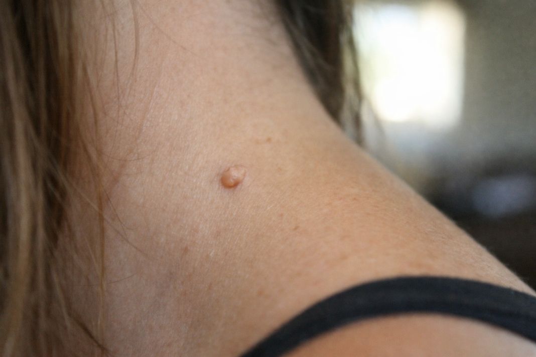 Skin Tag Removal in Abu Dhabi