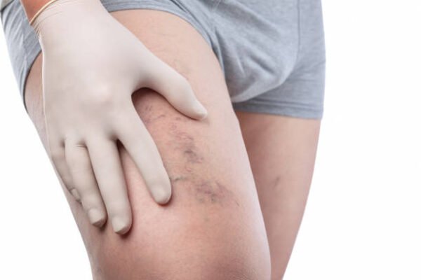 Is Spider Veins Treatment the best vein solution