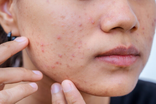 Subcision Treatment for Acne Scars in Abu Dhabi