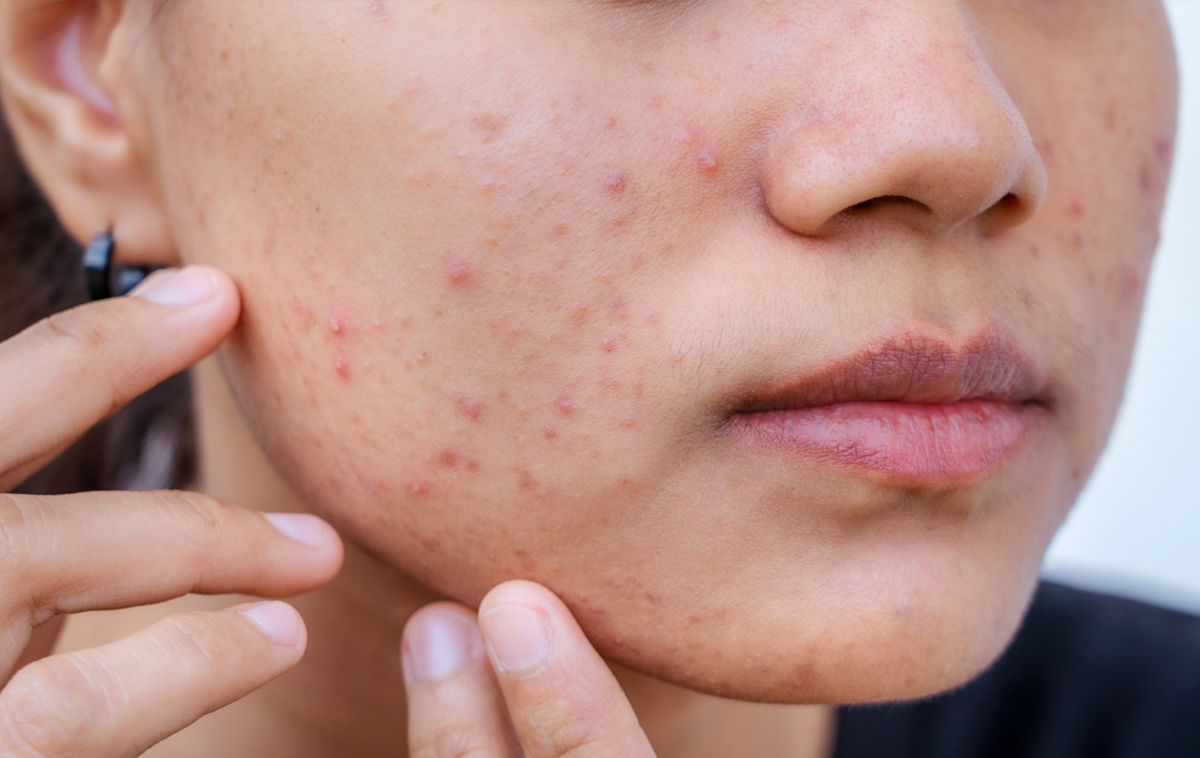 Subcision Treatment for Acne Scars in Abu Dhabi
