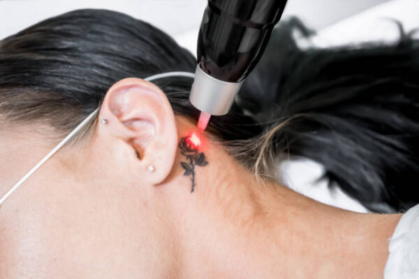 Is laser tattoo removal the best tattoo solution