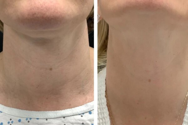 Best Doctors in dubai for Non-Surgical Skin Rejuvenation with Radiofrequency Microneedling
