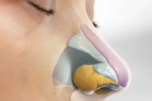 rhinoplasty surgery in Gurgaon