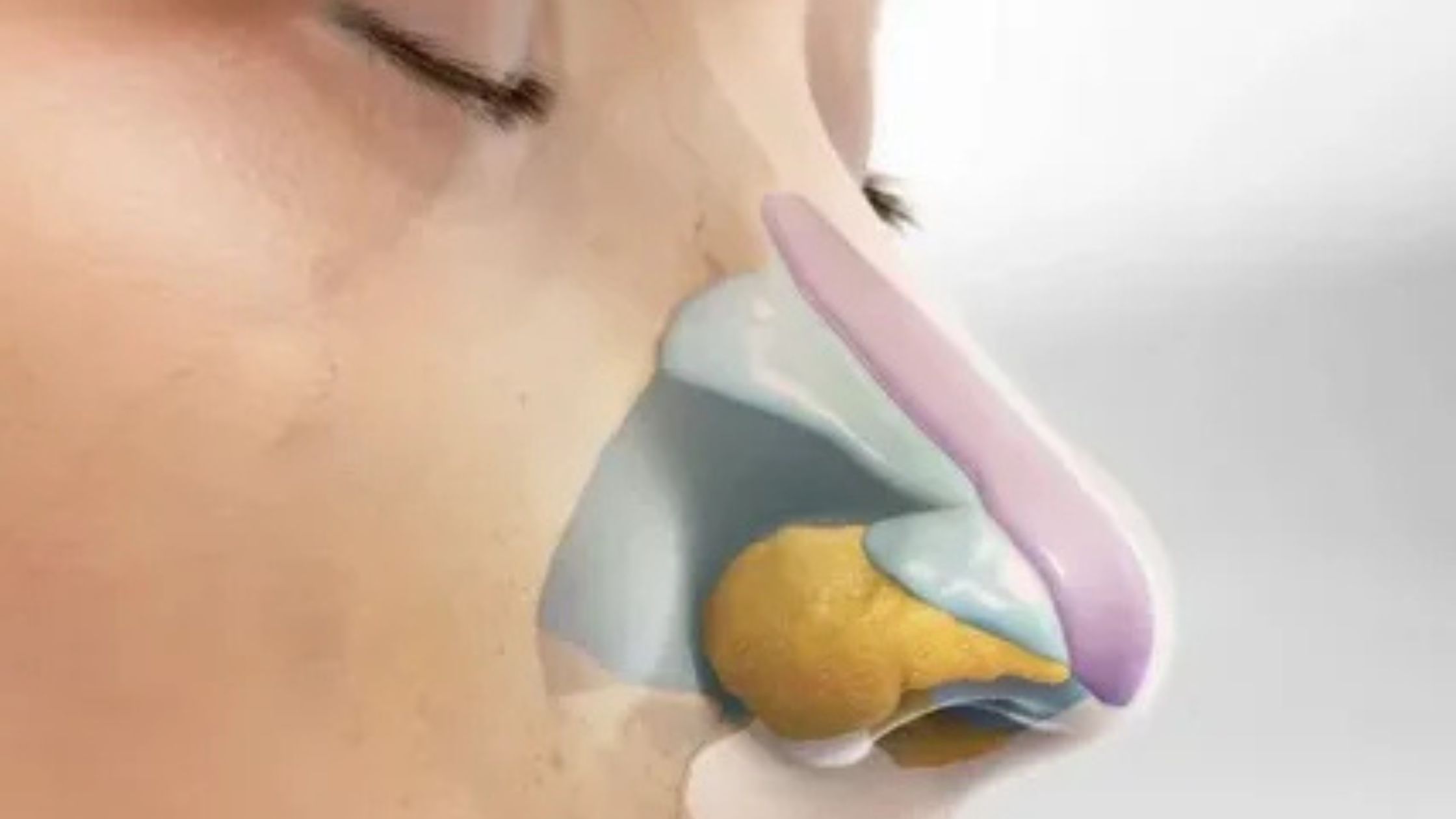 rhinoplasty surgery in Gurgaon