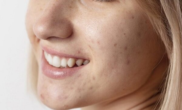 Acne Treatment in Abu Dhabi
