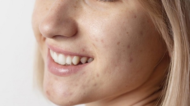 Acne Treatment in Abu Dhabi