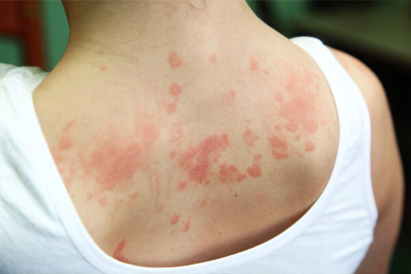 Skin Diseases Treatment in Abu Dhabi