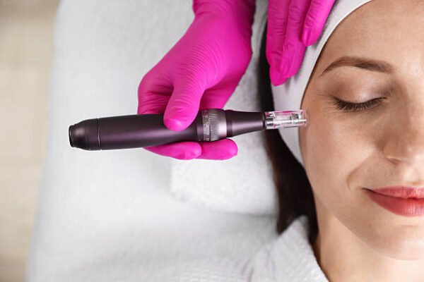 What Results Can Microneedling for Acne Scars Deliver