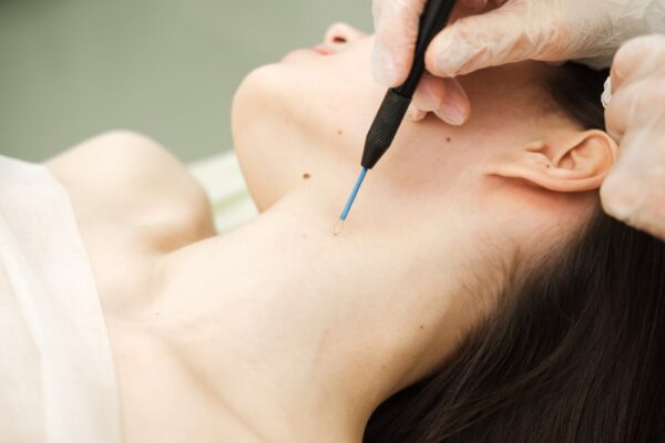 Mole Removal in Abu Dhabi