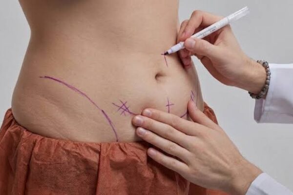 Lipo abdominoplasty in Abu Dhabi
