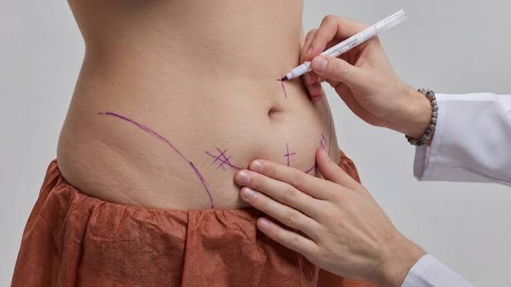 Lipo abdominoplasty in Abu Dhabi