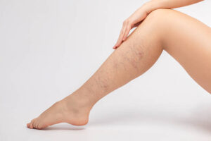 Who Should Consider Spider Veins Treatment