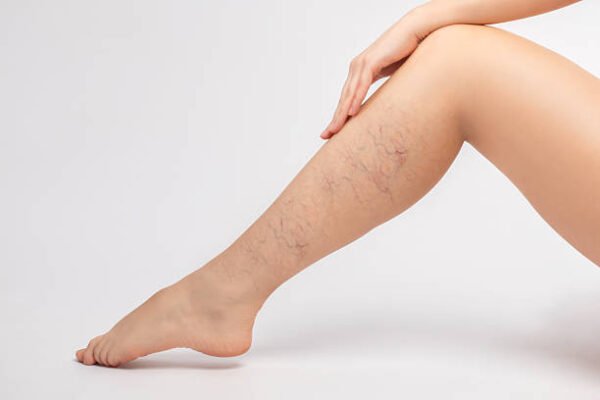Who Should Consider Spider Veins Treatment