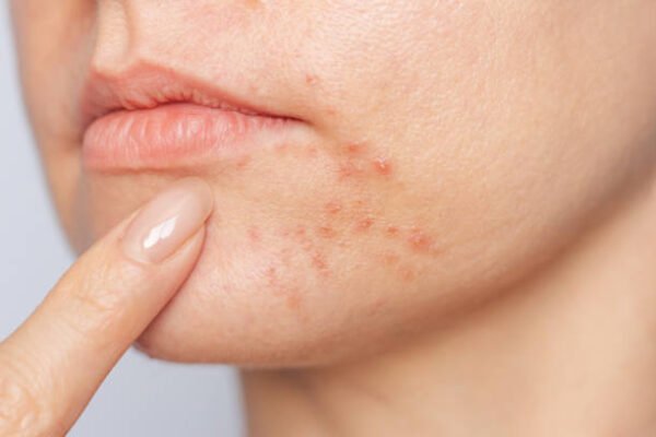 Why Choose Acne Treatment for Clearer Skin
